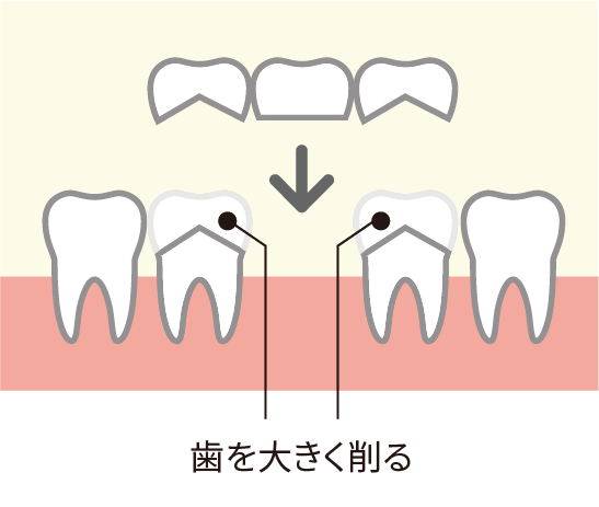 歯を大きく削る