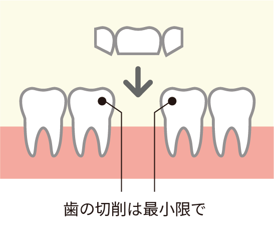 歯の切削は最小限で
