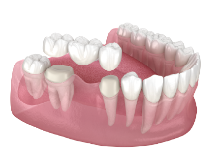 ブリッジ治療のイメージ画像