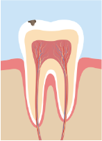 エナメル質内にとどまる虫歯のイラスト