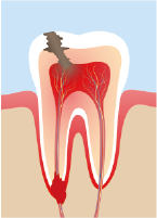 歯の根だけが残っている状態のイラスト