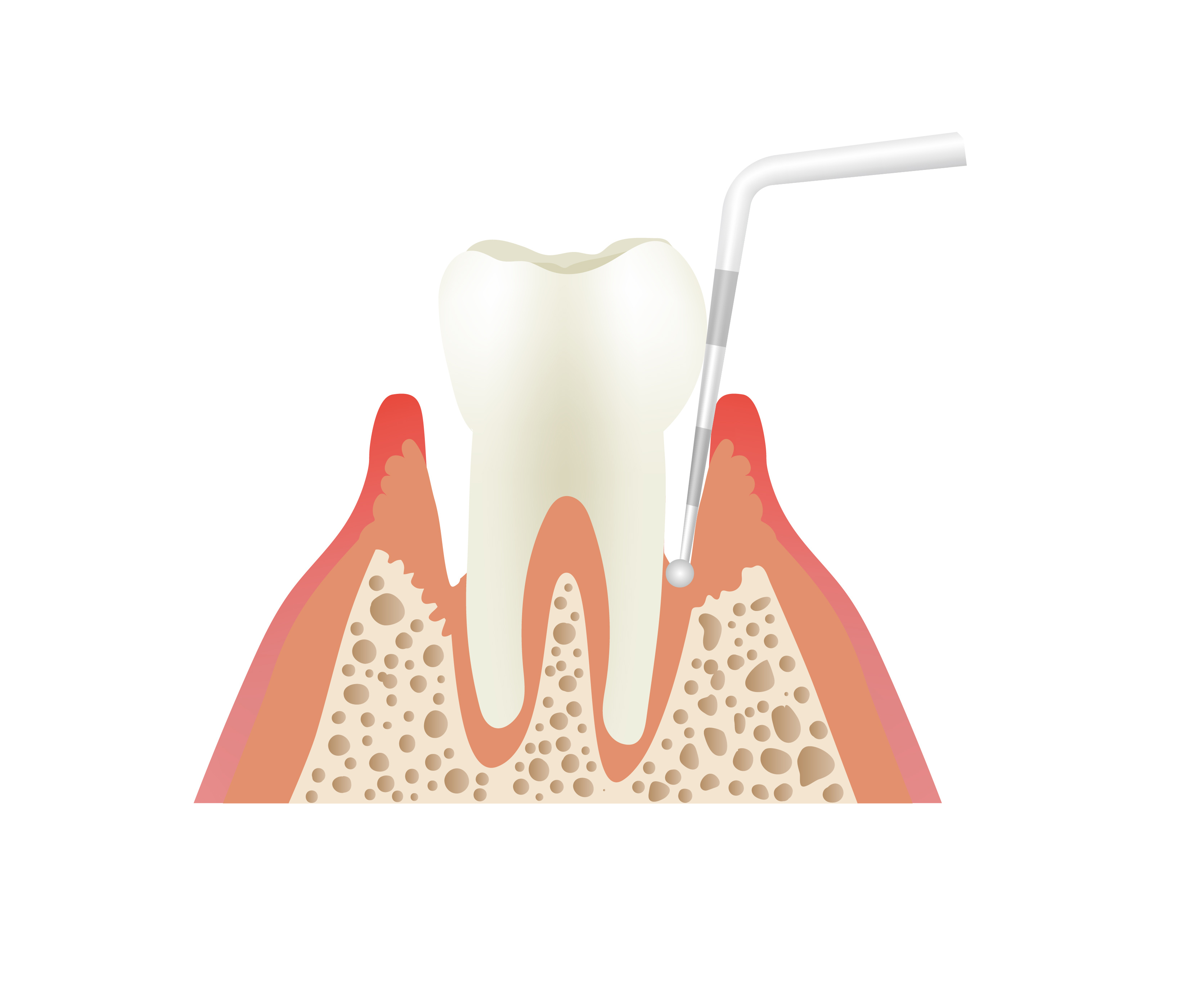 歯周ポケットの図